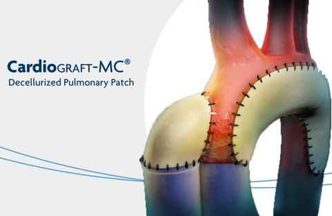 CardioGraft-MC Decellularized Pulmonary Patch